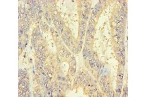 Immunohistochemistry of paraffin-embedded human endometrial cancer using ABIN7151338 at dilution of 1:100 (INSL4 antibody  (AA 30-139))