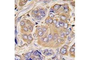 Formalin-fixed and paraffin-embedded human breast carcinoma tissue reacted with HSPB1 Antibody , which was peroxidase-conjugated to the secondary antibody, followed by DAB staining.