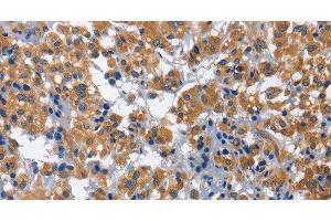 Immunohistochemistry of paraffin-embedded Human thyroid cancer using HSF27 Polyclonal Antibody at dilution of 1:60 (CDK5RAP3 antibody)