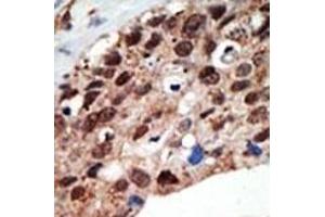 Formalin-fixed and paraffin-embedded human cancer tissue reacted with the primary antibody, which was peroxidase-conjugated to the secondary antibody, followed by DAB staining. (SETD7 antibody  (AA 159-189))