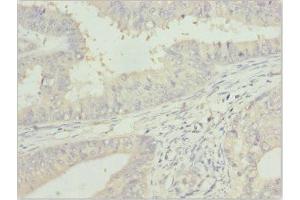 Immunohistochemistry of paraffin-embedded human endometrial cancer using ABIN7144060 at dilution of 1:100 (ZFAND3 antibody  (AA 1-227))