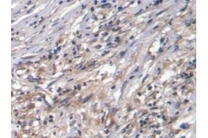 Detection of CTGF in Human Ovarian cancer Tissue using Polyclonal Antibody to Connective Tissue Growth Factor (CTGF) (CTGF antibody  (AA 80-200))