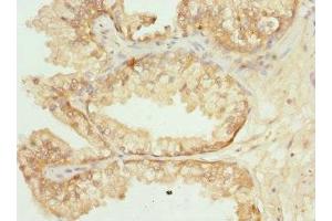 Immunohistochemistry of paraffin-embedded human prostate cancer using ABIN7162350 at dilution of 1:100 (GPR68 antibody  (AA 276-365))