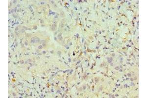 Immunohistochemistry of paraffin-embedded human lung cancer using ABIN7162504 at dilution of 1:100 (PAX6 antibody  (AA 1-300))