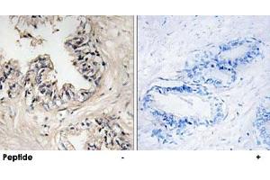 Immunohistochemistry analysis of paraffin-embedded human breast carcinoma tissue using MRPS36 polyclonal antibody . (MRPS36 antibody)