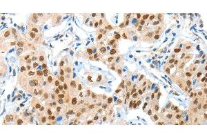 Immunohistochemistry of paraffin-embedded Human lung cancer using APPL1 Polyclonal Antibody at dilution of 1:70 (APPL1 antibody)