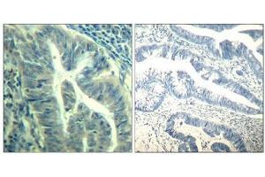 Immunohistochemical analysis of paraffin-embedded human colon carcinoma tissue using CDK6(Phospho-Tyr24) Antibody(left) or the same antibody preincubated with blocking peptide(right). (CDK6 antibody  (pTyr24))