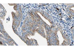 ABIN6272405 at 1/100 staining Human cervical cancer tissue by IHC-P.