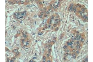 Detection of HSPA1A in Human Liver cancer Tissue using Anti-Heat Shock 70 kDa Protein 1A (HSPA1A) Monoclonal Antibody (HSP70 1A antibody  (AA 285-641))