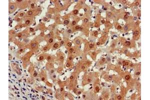 Immunohistochemistry of paraffin-embedded human liver cancer using ABIN7164960 at dilution of 1:100 (PSMA5 antibody  (AA 124-180))