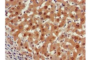 Immunohistochemistry of paraffin-embedded human liver cancer using ABIN7164960 at dilution of 1:100