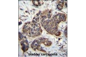 GOT1B Antibody (C-term) (ABIN657018 and ABIN2846197) immunohistochemistry analysis in formalin fixed and paraffin embedded human bladder carcinoma followed by peroxidase conjugation of the secondary antibody and DAB staining. (GOLT1B antibody  (C-Term))