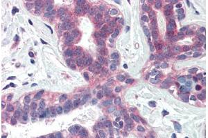 Human Breast (formalin-fixed, paraffin-embedded) stained with XBP1 antibody ABIN337110 at 5 ug/ml followed by biotinylated anti-goat IgG secondary antibody ABIN481715, alkaline phosphatase-streptavidin and chromogen. (XBP1 antibody  (AA 358-372))