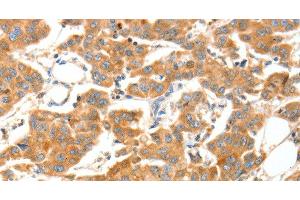 Immunohistochemistry of paraffin-embedded Human breast cancer tissue using ADAMTS18 Polyclonal Antibody at dilution 1:30 (ADAMTS18 antibody)