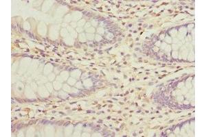 Immunohistochemistry of paraffin-embedded human colon cancer using ABIN7163881 at dilution of 1:100 (GALNT2 antibody  (AA 442-571))