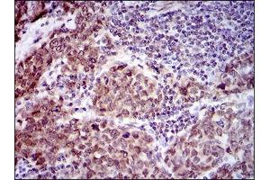 Immunohistochemical analysis of paraffin-embedded breast cancer tissues using CLGN mouse mAb with DAB staining. (Calmegin antibody  (AA 249-405))
