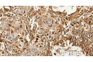 Immunohistochemistry of paraffin-embedded Human esophagus cancer tissue using SLC9A7 Polyclonal Antibody at dilution 1:60 (NHE7 antibody)