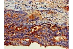 Immunohistochemistry of paraffin-embedded human colon cancer using ABIN7146803 at dilution of 1:100 (CEACAM6 antibody  (AA 35-320))