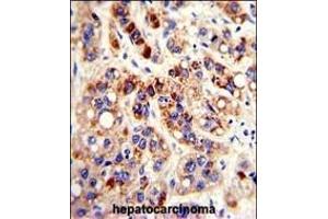 Formalin-fixed and paraffin-embedded human hepatocarcinoma with PON3 Antibody (N-term), which was peroxidase-conjugated to the secondary antibody, followed by DAB staining. (PON3 antibody  (N-Term))