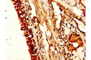 IHC image of ABIN7161954 diluted at 1:200 and staining in paraffin-embedded human lung cancer performed on a Leica BondTM system. (NUCB2 antibody  (AA 25-106))