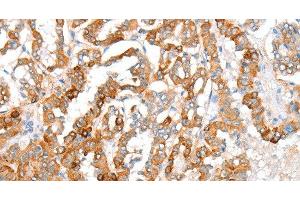 Immunohistochemistry of paraffin-embedded Human thyroid cancer using ACY3 Polyclonal Antibody at dilution of 1:35 (Aminoacylase 3 antibody)