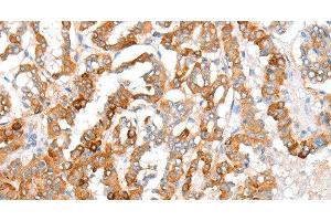Immunohistochemistry of paraffin-embedded Human thyroid cancer using ACY3 Polyclonal Antibody at dilution of 1:35