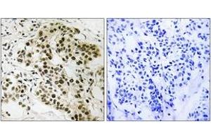 Immunohistochemistry analysis of paraffin-embedded human breast carcinoma tissue, using Retinoblastoma (Ab-252) Antibody.