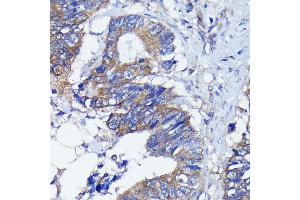 Immunohistochemistry of paraffin-embedded human colon carcinoma using PKC alpha antibody (ABIN6128460, ABIN6135858, ABIN6135859 and ABIN7101370) at dilution of 1:100 (40x lens). (PKC alpha antibody)