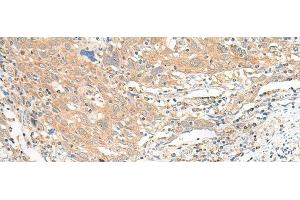 Immunohistochemistry of paraffin-embedded Human cervical cancer tissue using SLC6A9 Polyclonal Antibody at dilution of 1:25(x200) (GLYT1 antibody)