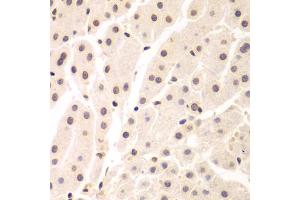 Immunohistochemistry of paraffin-embedded human liver cancer using UHRF2 antibody. (UHRF2 antibody)