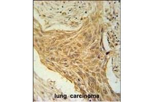 CSAG2 Antibody (N-term) (ABIN651616 and ABIN2840327) immunohistochemistry analysis in formalin fixed and paraffin embedded human lung carcinoma followed by peroxidase conjugation of the secondary antibody and DAB staining. (CSAG2 antibody  (N-Term))