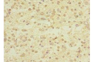 Immunohistochemistry of paraffin-embedded human glioma using ABIN7174375 at dilution of 1:100 (UBE4A antibody  (AA 797-1066))