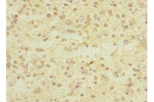 Immunohistochemistry of paraffin-embedded human glioma using ABIN7174375 at dilution of 1:100