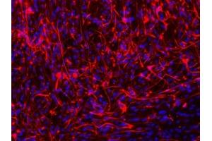 Immunofluorescence staining of paraffin-embedded Glioma cells of Spinal Cord using MAP2 Antibody. (MAP2 antibody)