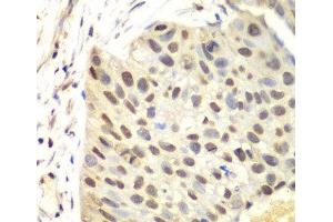 Immunohistochemistry of paraffin-embedded Human lung cancer using FEN1 Polyclonal Antibody at dilution of 1:100 (40x lens). (FEN1 antibody)