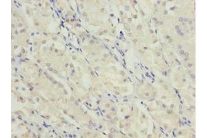 Immunohistochemistry of paraffin-embedded human gastric cancer using ABIN7174959 at dilution of 1:100 (MYO5C antibody  (AA 270-420))