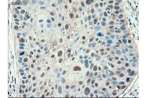 Immunohistochemical staining of paraffin-embedded Adenocarcinoma of colon using anti-PTCH1 (ABIN2452537) mouse monoclonal antibody. (Patched 1 antibody  (AA 122-436))
