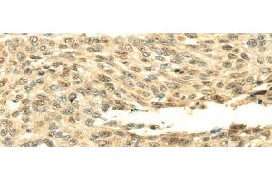 Immunohistochemistry of paraffin-embedded Human lung cancer tissue using SHPRH Polyclonal Antibody at dilution 1:45 (SHPRH antibody)