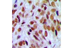 Immunohistochemical analysis of UBF staining in human breast cancer formalin fixed paraffin embedded tissue section. (UBTF antibody)