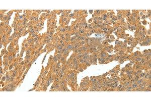 Immunohistochemistry of paraffin-embedded Human ovarian cancer using SKP1 Polyclonal Antibody at dilution of 1:30 (SKP1 antibody)