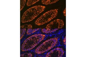 Immunofluorescence analysis of human colon carcinoma using GP Rabbit mAb (ABIN1682863, ABIN3017875, ABIN3017876 and ABIN7101532) at dilution of 1:100 (40x lens). (GPA33 antibody)