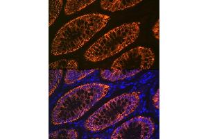 Immunofluorescence analysis of human colon carcinoma using GP Rabbit mAb (ABIN1682863, ABIN3017875, ABIN3017876 and ABIN7101532) at dilution of 1:100 (40x lens).