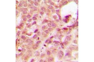 Immunohistochemical analysis of ABL1 staining in human breast cancer formalin fixed paraffin embedded tissue section. (ABL1 antibody  (N-Term))