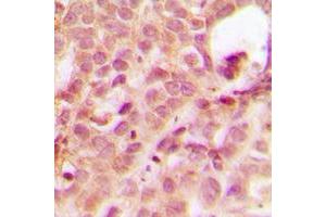 Immunohistochemical analysis of ABL1 staining in human breast cancer formalin fixed paraffin embedded tissue section. (ABL1 antibody  (N-Term))