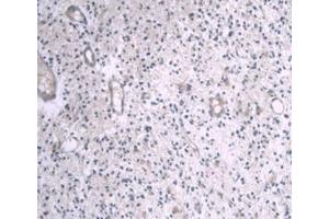IHC-P analysis of Human Glioma Tissue, with DAB staining. (APOA1 antibody  (AA 122-267))