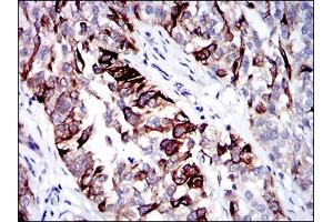 Immunohistochemical analysis of paraffin-embedded bladder cancer tissues using CK5 mouse mAb with DAB staining. (Cytokeratin 5 antibody  (AA 316-590))
