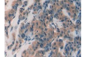 Detection of GAL2 in Human Breast cancer Tissue using Polyclonal Antibody to Galectin 2 (GAL2) (Galectin 2 antibody  (AA 1-132))