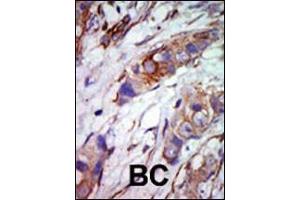 Formalin-fixed and paraffin-embedded human cancer tissue reacted with the primary antibody, which was peroxidase-conjugated to the secondary antibody, followed by AEC staining. (MAPK7 antibody  (C-Term))