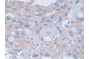 Detection of RARa in Human Breast cancer Tissue using Polyclonal Antibody to Retinoic Acid Receptor Alpha (RARa) (Retinoic Acid Receptor alpha antibody  (AA 68-173))