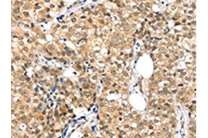 The image on the left is immunohistochemistry of paraffin-embedded Human breast cancer tissue using ABIN7192874(TPR Antibody) at dilution 1/20, on the right is treated with synthetic peptide. (TPR antibody)